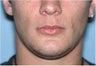Before/After Genioplasty (Chin Surgery)