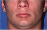 Before/After Genioplasty (Chin Surgery)