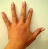 Hand Rejuvenation