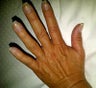 Hand Rejuvenation