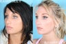 Rhinoplasty