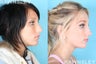 Rhinoplasty