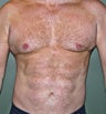 45 Year Old Male Who Desired 6-Pak Abs