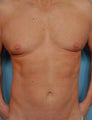 45 Year Old Male Who Desired 6-Pak Abs