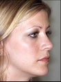 Revision rhinoplasty