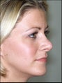 Revision rhinoplasty