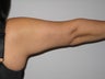 53 Year Old Woman with Brachioplasty