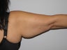 53 Year Old Woman with Brachioplasty