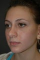 Secondary septorhinoplasty for correction of asymmetry and obstruction.