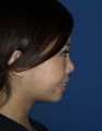 Revision Rhinoplasty with Chin Implant