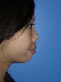 Revision Rhinoplasty with Chin Implant