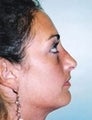 Female patient who underwent nose surgery with a chin implant