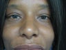 Rhinoplasty, 42 Year Old Female