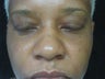 Rhinoplasty, 42 Year Old Female