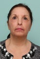 Laser Resurfacing
