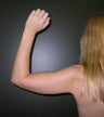 Liposuction of Arms