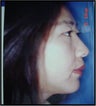 22 Year Old Female treated for Unacceptable Cosmetic Appearance of Face