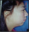 22 Year Old Female treated for Unacceptable Cosmetic Appearance of Face