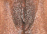 Vaginoplasty
