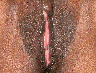 Vaginoplasty