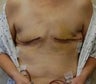 Bilateral DIEP Flap Breast Reconstruction