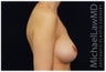 Breast Augmentation