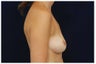 Breast Augmentation