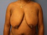 36 yo female breast lift / mastopexy