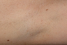 Laser Hair Removal