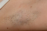 Laser Hair Removal