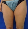 Laser Liposuction