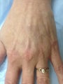 56 year old female with large hand veins.