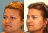 Reduction Rhinoplasty