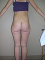 Liposuction