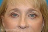 Upper and Lower Blepharoplasty