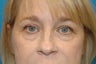 Upper and Lower Blepharoplasty