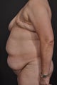 Breast Reconstruction