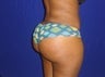 21 Year Young Patient, had Butt Augmentation with Fat Grafting 4 years ago