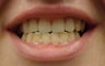 Female Fitted with Partial Dentures