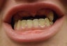 Female Fitted with Partial Dentures