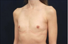 Breast Augmentation