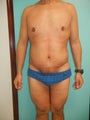45 Year Old Male - Tummy Tuck