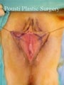 Labial Reduction