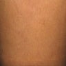 Patient who underwent vein sclerotherapy for leg spider veins