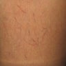 Patient who underwent vein sclerotherapy for leg spider veins