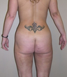 Liposuction