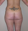 Liposuction