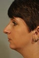 Adding a chin implant to balance the face