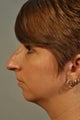 Adding a chin implant to balance the face