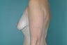 Breast Lift